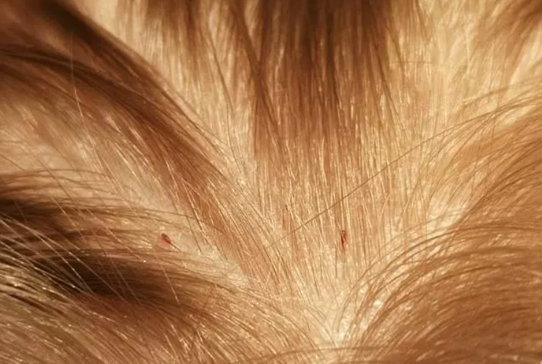 New Species of Lice Is Alarming Parents Around Australia As They Are