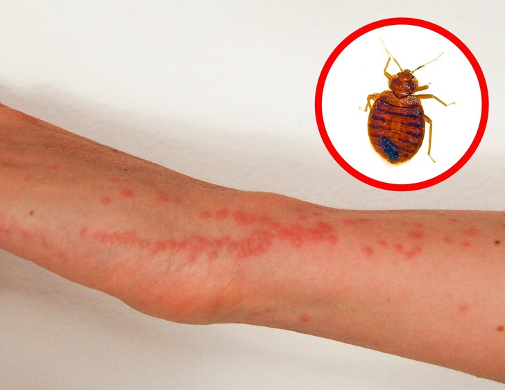 How to Identify a Bug Bite and What to Do With It