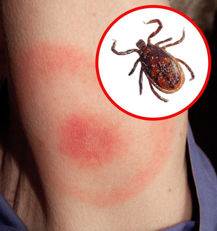 Tips On How To Antidote And Recognize The Bug Bites - Small Joys