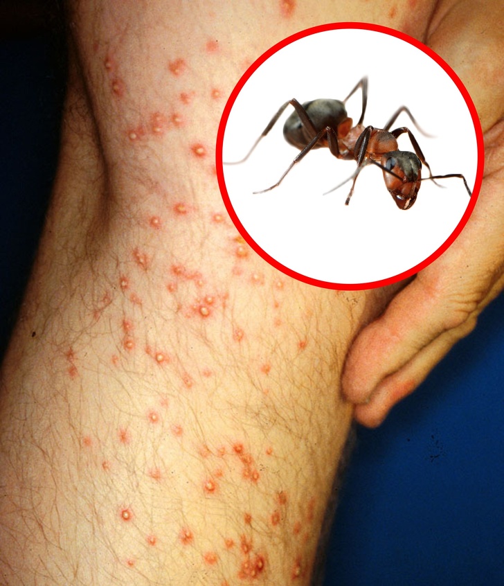 How to Identify a Bug Bite and What to Do With It