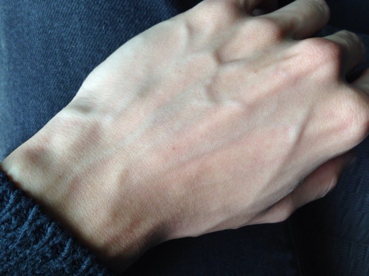 Resultado de imagen de Venas hinchadas