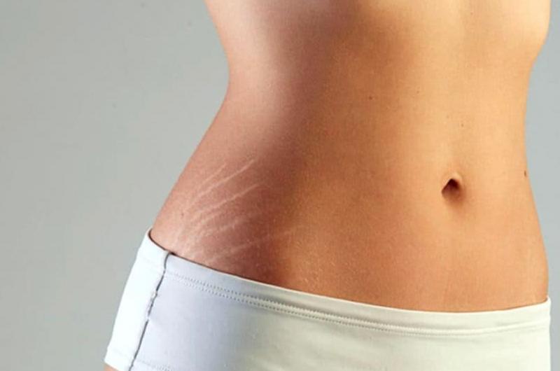 Resultado de imagen de estrias