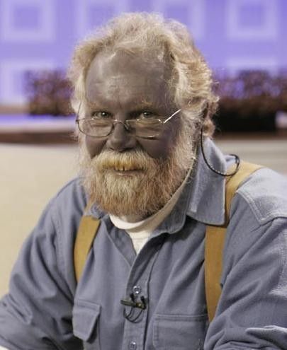 Resultado de imagen de SÃ­ndrome deÂ argiria