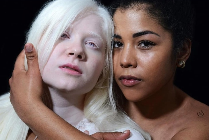 clichés qui dévoilent la beauté des Albinos Vonjour