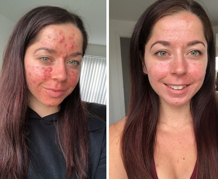 Woman With Severe Cystic Acne Bravely Shared Her Photos Online Small Joys 