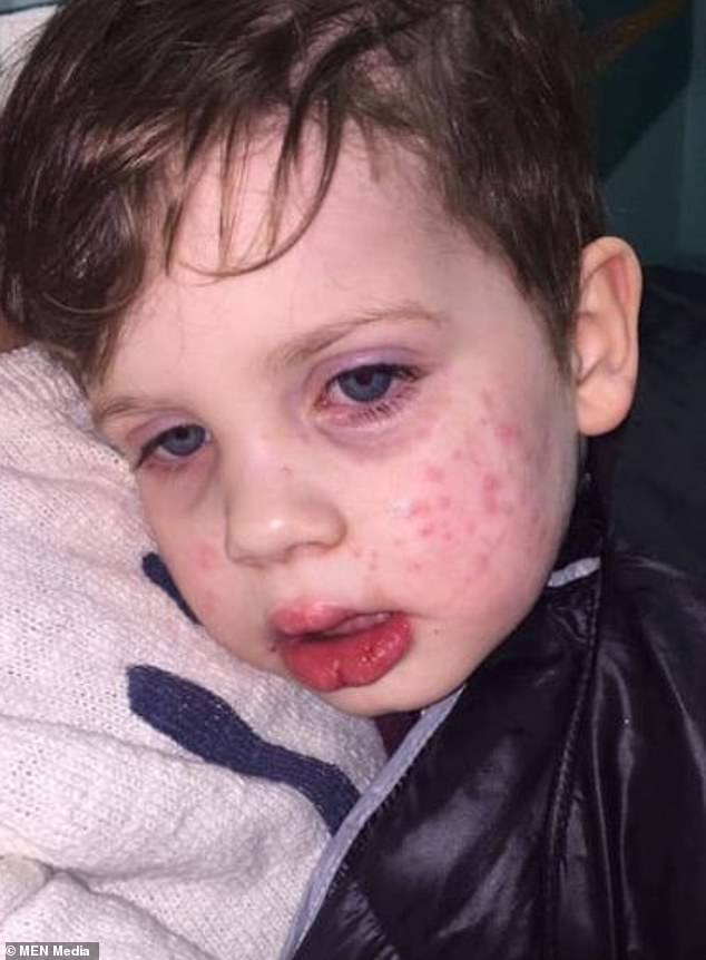 mom-warned-parents-against-herpes-after-her-3-year-old-caught-it-when