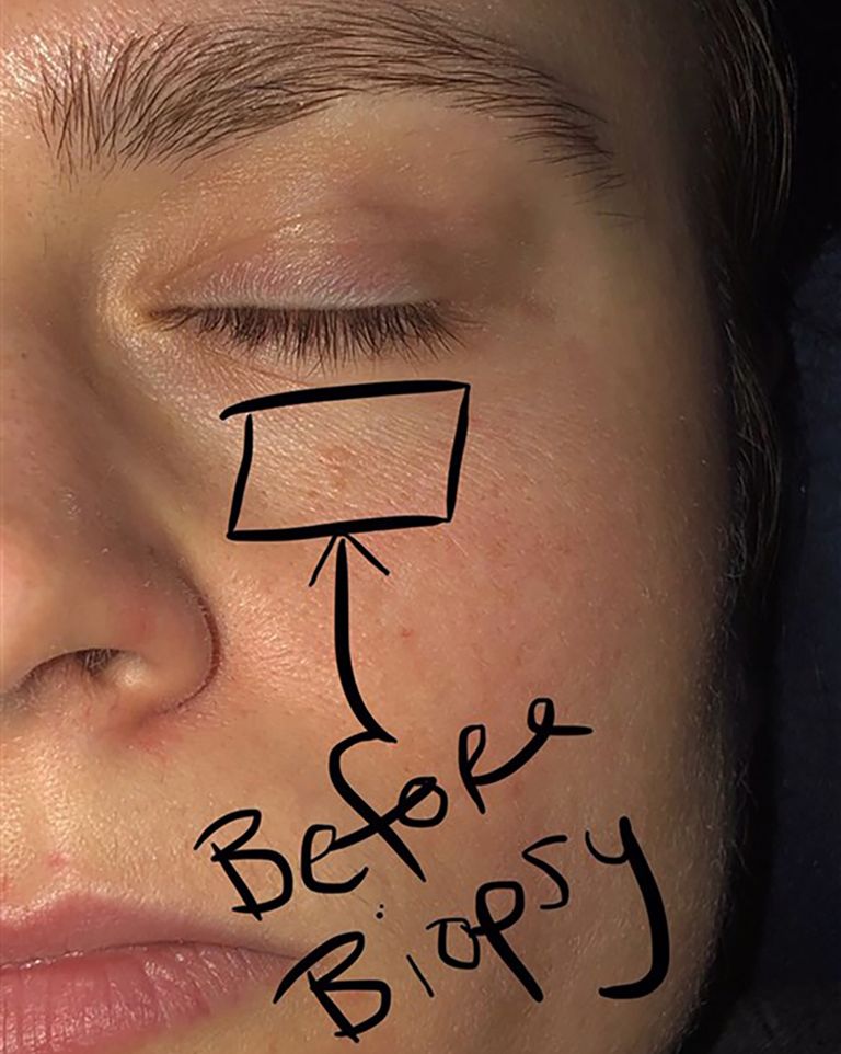 woman-s-small-pimple-under-her-eye-turned-out-to-be-skin-cancer-small