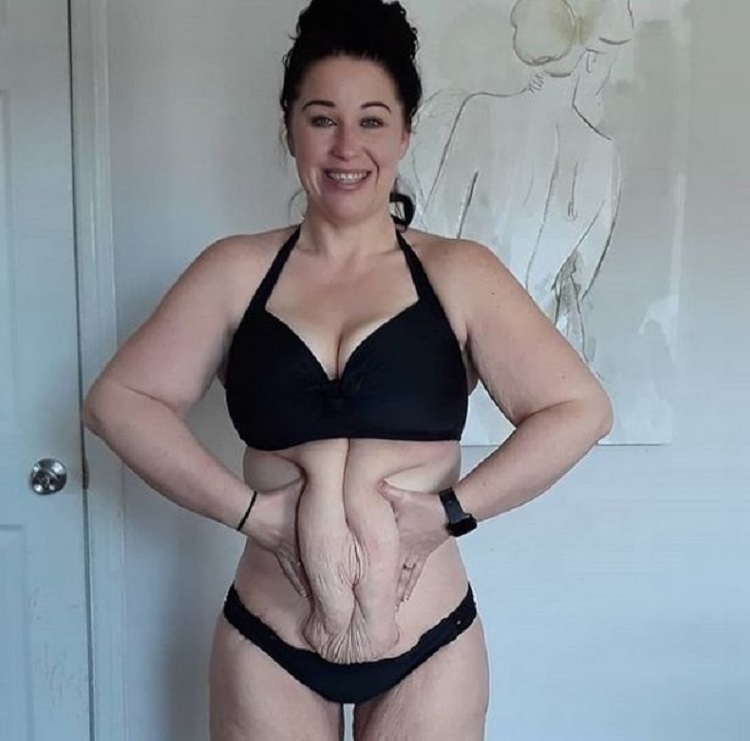 A Woman Lost An Incredible 234 Lbs But Had To Undergo Surgery To Remove The Excess Skin Small 