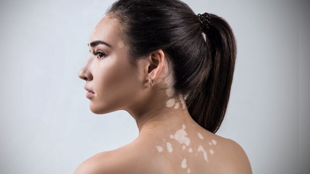 Resultado de imagen de vitiligo