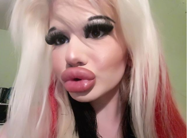Une femme de 22 ans a quadruplé la taille de ses lèvres après 17 ...