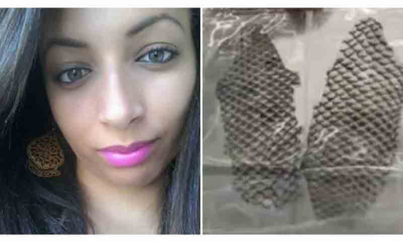 Resultado de imagen de Woman born without vagina gets one made from tilapia fish skin"