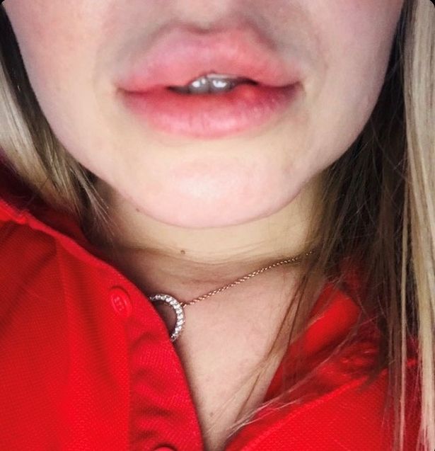 Woman Warns After Her Lips Were Injected With Wrong Chemicals By A ...