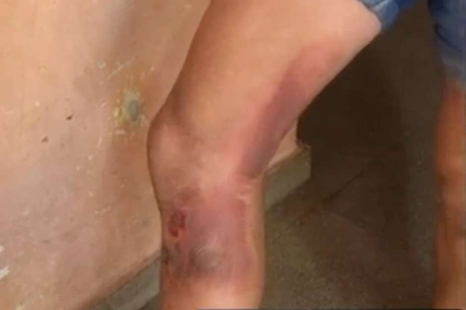 Resultado de imagen de Catriel Gómez quemaduras movil