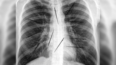 Resultado de imagen de agujas en cuerpo