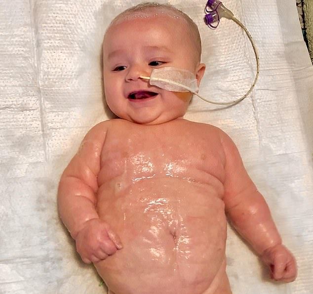 Baby Boy’s Bladder Ballooned In Size And ‘Crushed His Kidney’ Due To A Rare Medical Condition