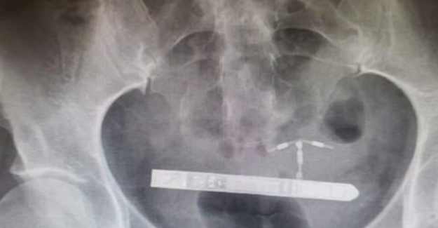 Resultado de imagen de vibrador atascado vejiga mujer