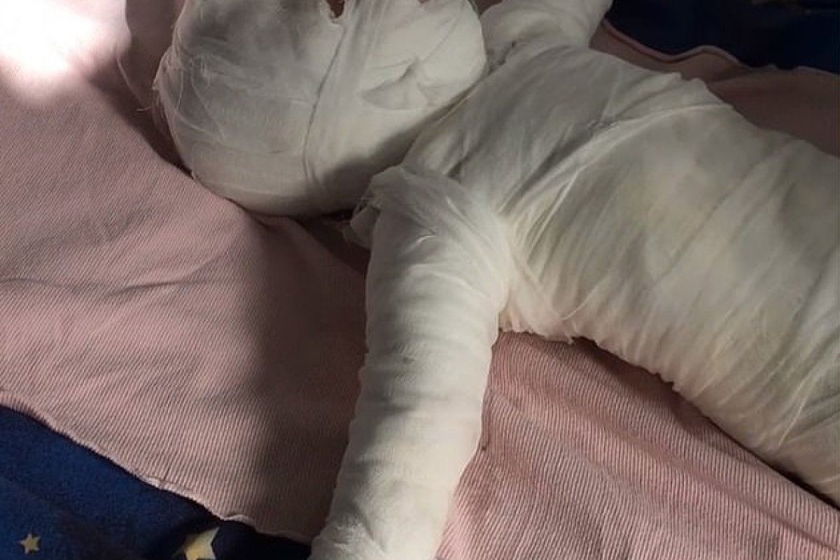 Fue hervido vivo": niño de once meses lucha por su vida tras caer ...