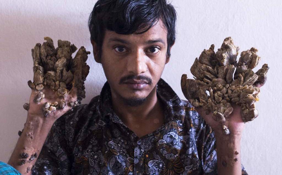 Hombre árbol pide que le amputen las manos por el dolor