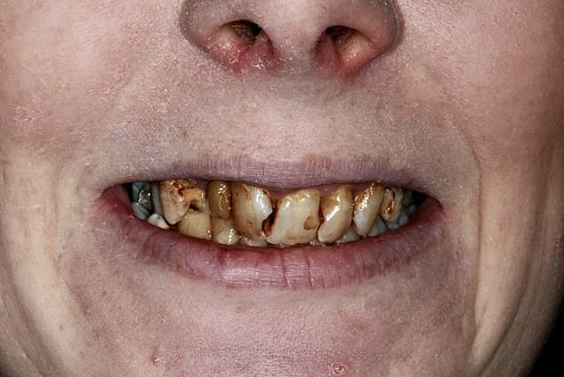 A Woman Who Was Recommended To Wear Dentures Due To Rotten T
