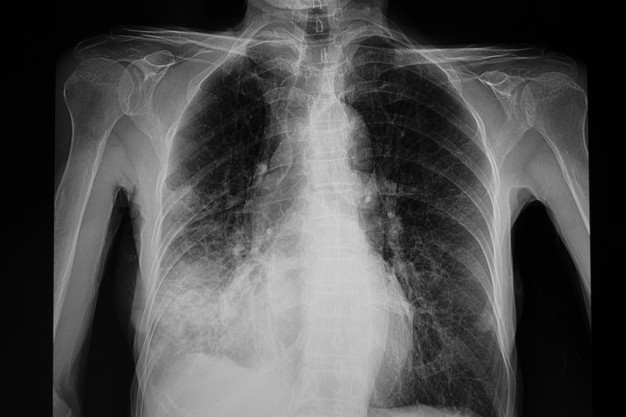 Neumonía pulmonar inferior derecha | Foto Premium