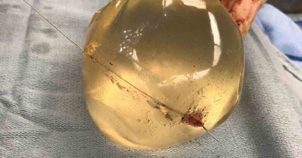 Womans Breast Implants Saved Her Life By Deflecting A Bullet From A Close Range Gunshot 0764