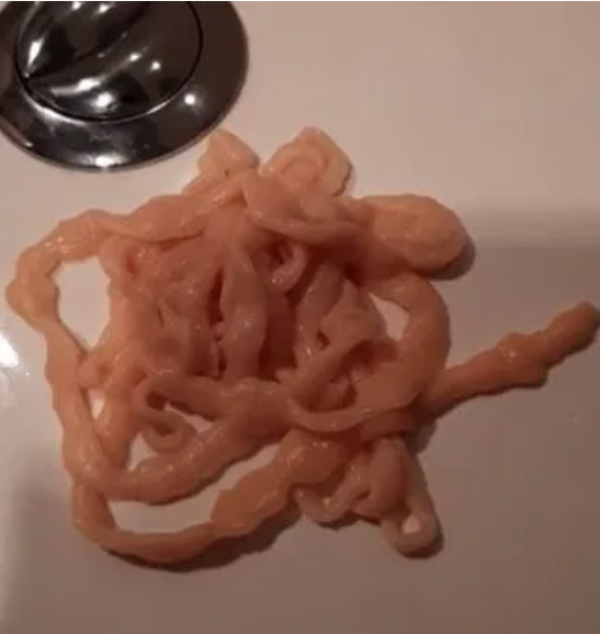 FOTOS: Siente picazón en el trasero y saca parásito de casi 10 metros