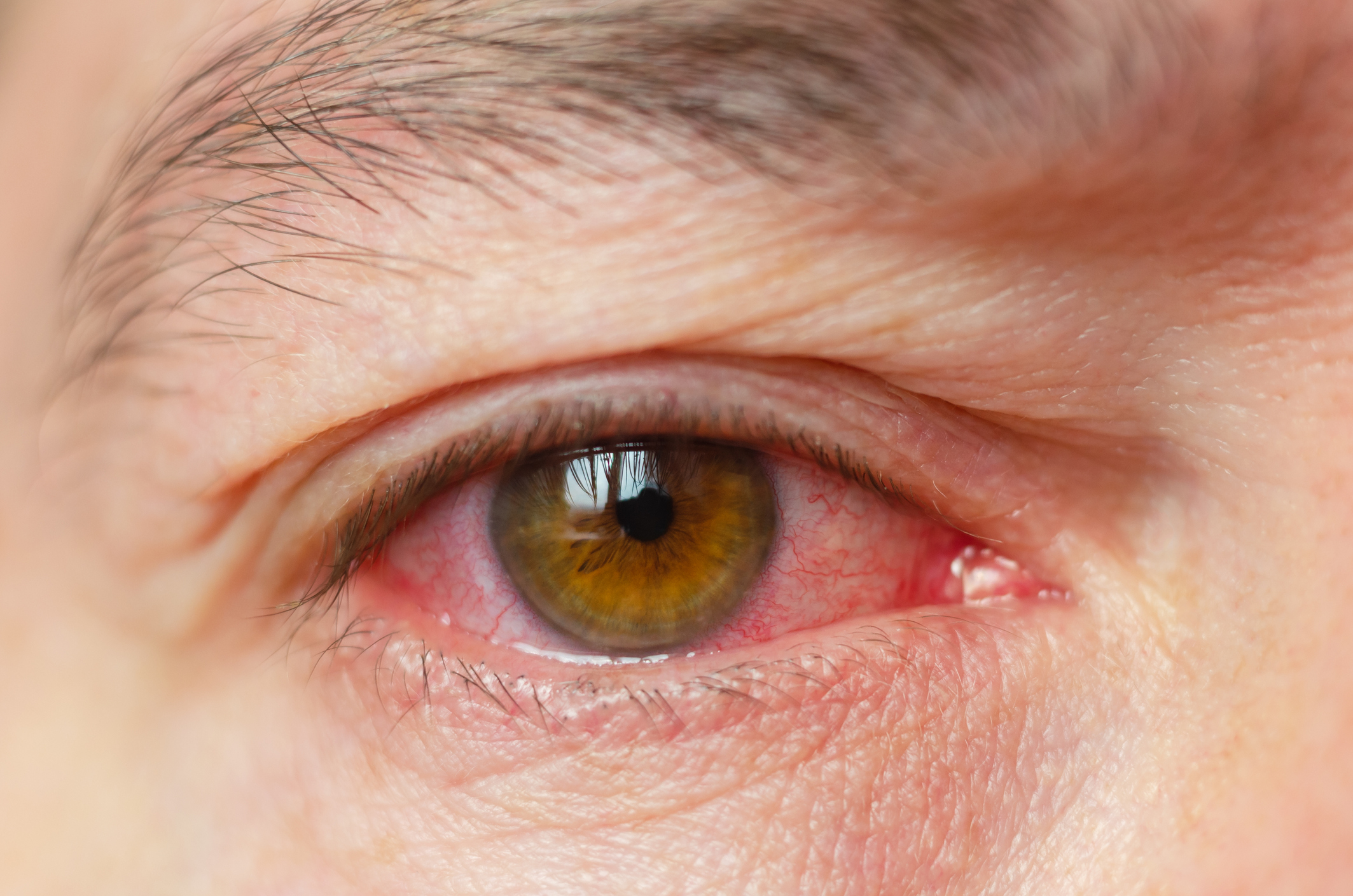 Are Red Eyes a Symptom of Coronavirus? Nurse Claims Patients Look ...