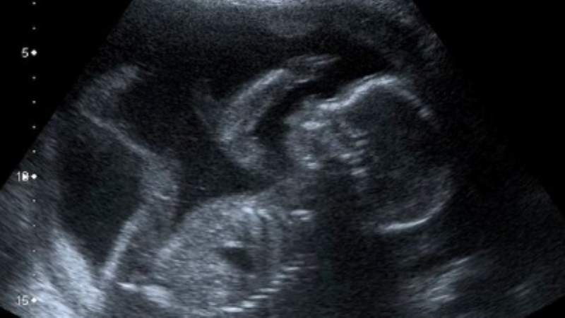 Un bebé murió decapitado cuando tiraron de sus piernas en el parto ...