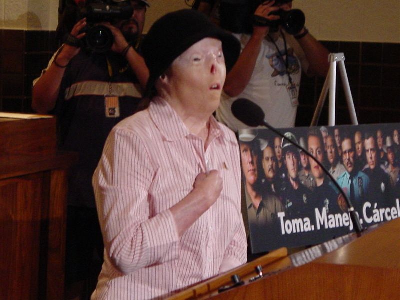 Fallece la venezolana que fue el rostro de las consecuencias de ...