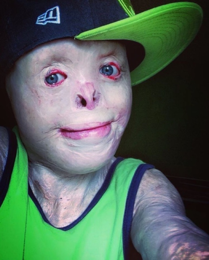 El fuego le robó el rostro y la infancia, pero no se dejó vencer ...