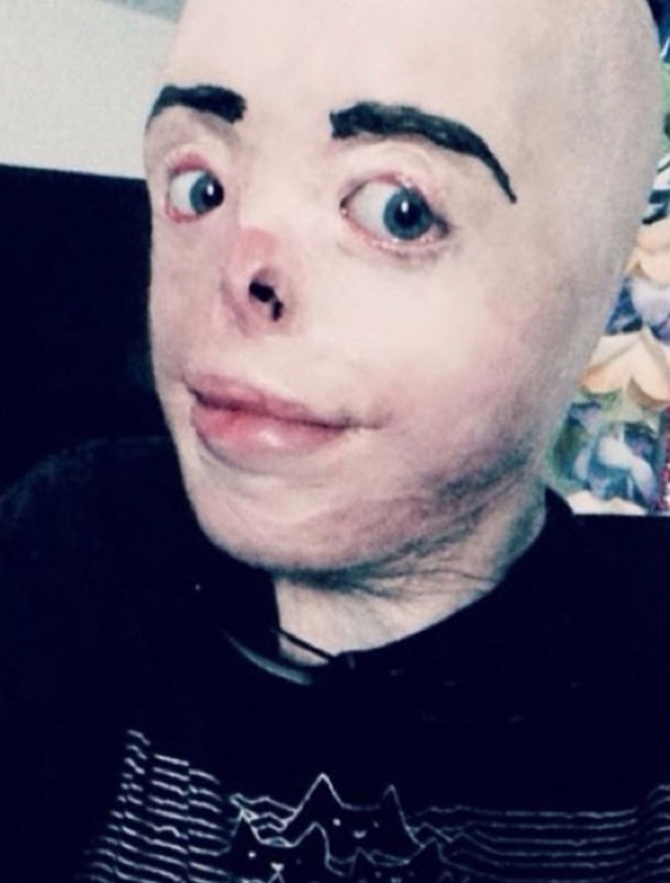 El fuego le arrebató su rostro, pero no dejó de luchar - Infobae