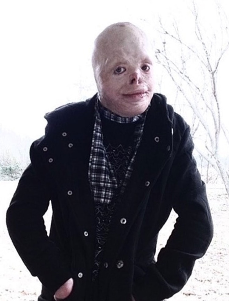 El fuego le arrebató su rostro, pero no dejó de luchar - Infobae