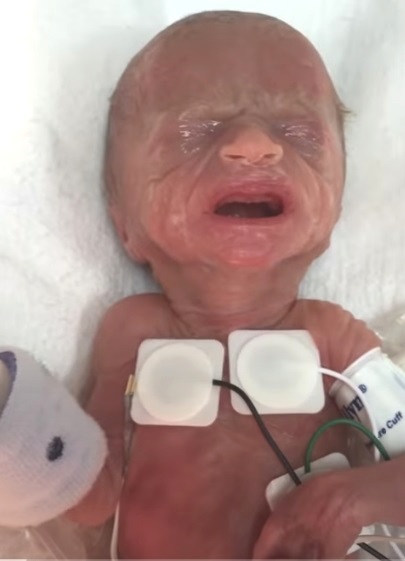 Pesaba medio kilo y contrajo más de 10 enfermedades, pero ella ...