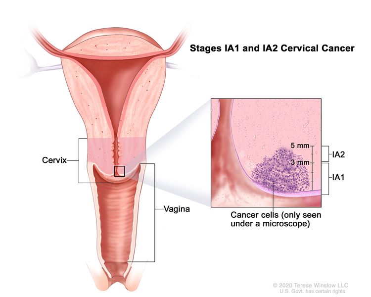 Cervical cancer symptoms at different stages