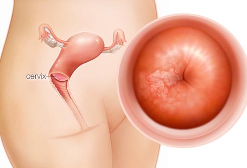 Cervical cancer symptoms
