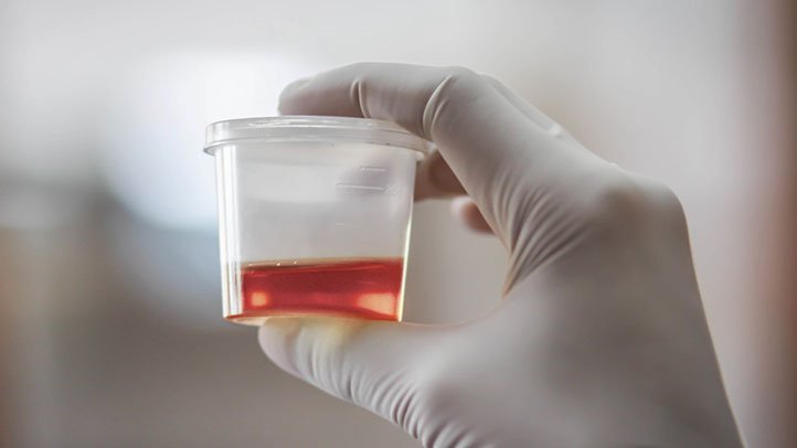 Red is not healthy urine color