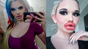 Woman Might Have Biggest Lips In The World After 17 injections