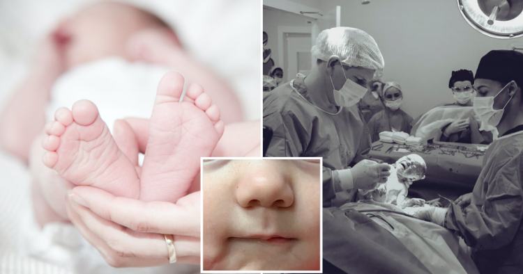 6-Month-Old Baby Undergoes Operation To Remove SECOND Mouth Complete