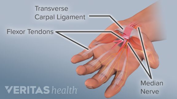 Everything You Need to Know About Carpal Tunnel Syndrome