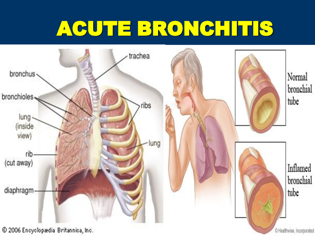 bronchitis contagious