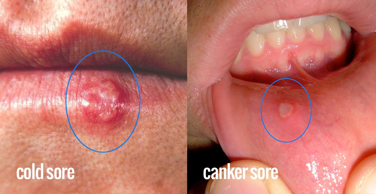 canker-sore-guide-to-treating-and-preventing-the-painful-sensations