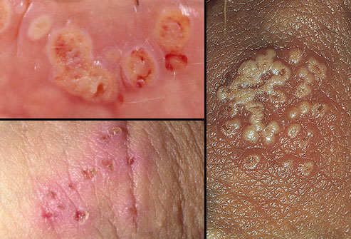 genital herpes