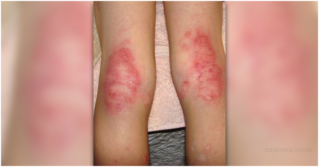 Staph Infection Causes Symptoms And Identifiable Risk Factors