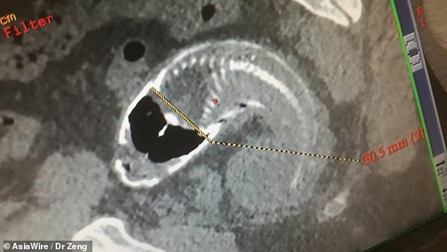 The medics had to surgically open the man’s belly to remove the dead fish from his rectum because the fish was ‘quite big’. The picture shows the Chinese patient