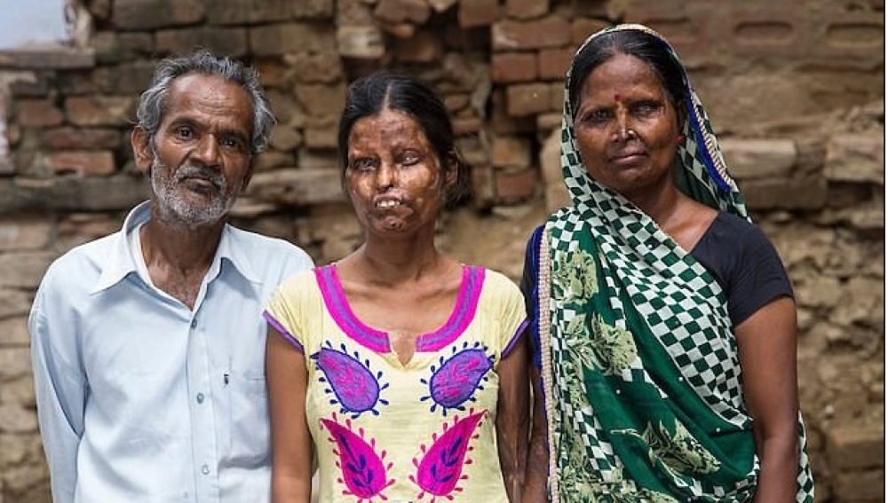 Una mujer vuelve con su marido después de que le atacase con ácido ...