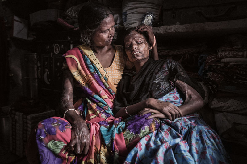 El drama de miles de mujeres en la India quemadas con ácido
