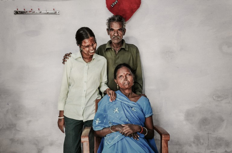 El drama de miles de mujeres en la India quemadas con ácido