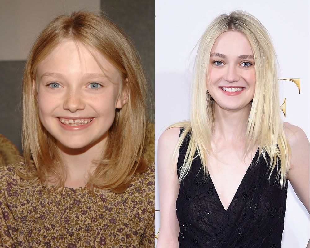 10 Stars Whose Braces Before And After Images Define Hollywood Smile