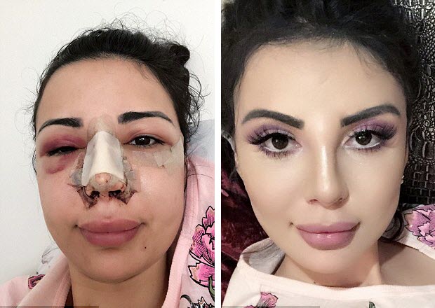 Plastic Surgery Addict Spends 05 Million On Ribs Removal Plus 20 More