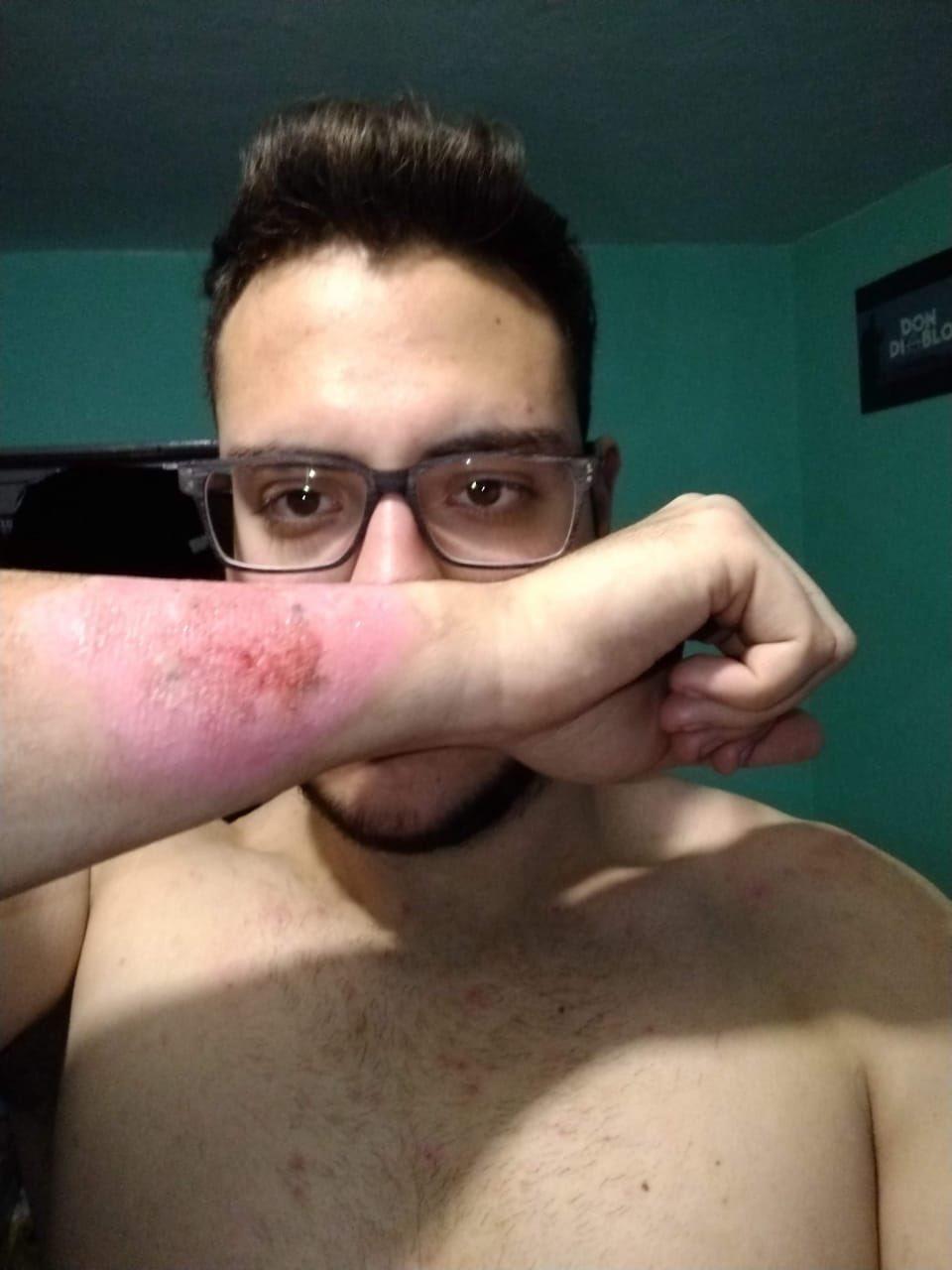 Un joven se quita un tatuaje que no le gustaba con un rallador de ...